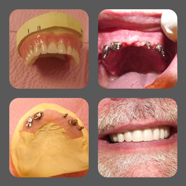 Before and After pictures of Dentures