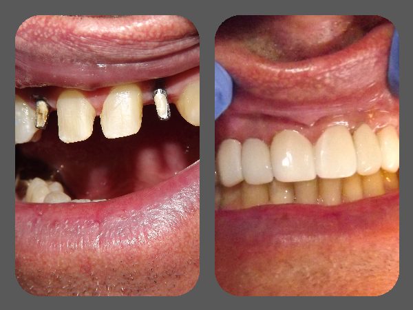 Before and After pictures of Dentures